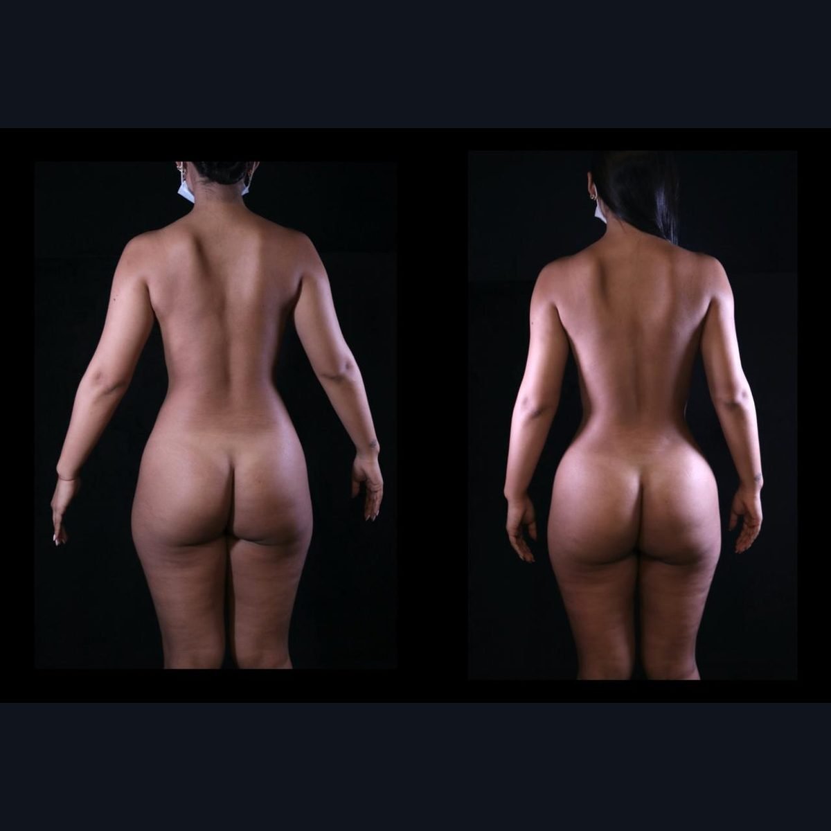 Gluteoplastia BBL en Bogotá: vista posterior antes y después con el Dr. Daniel Ramos