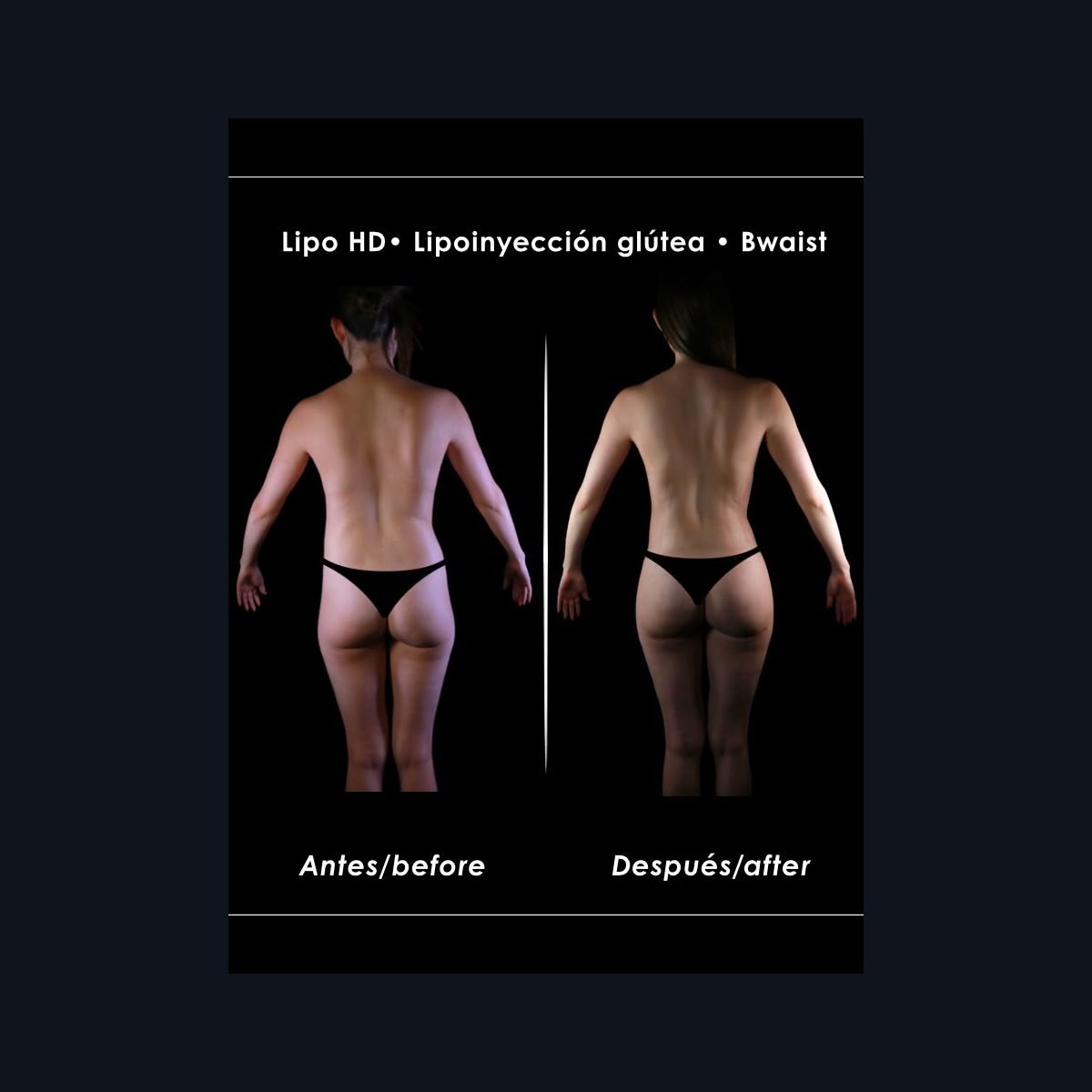 BBL con Lipo 360 en Bogotá: lipoinyección glútea y cintura marcada, antes y después