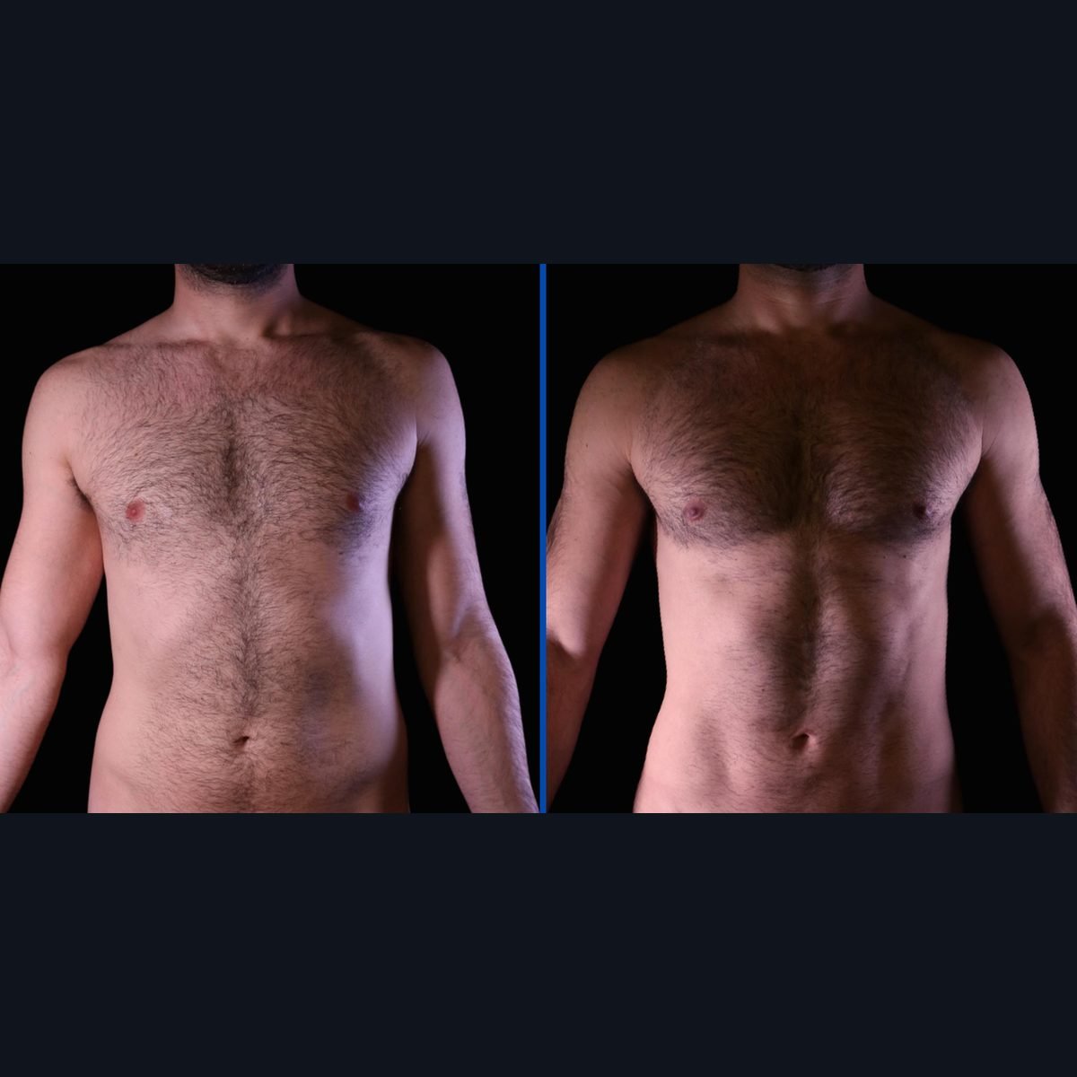 Contorno corporal de alta definición en hombres: abdomen antes y después, Bogotá