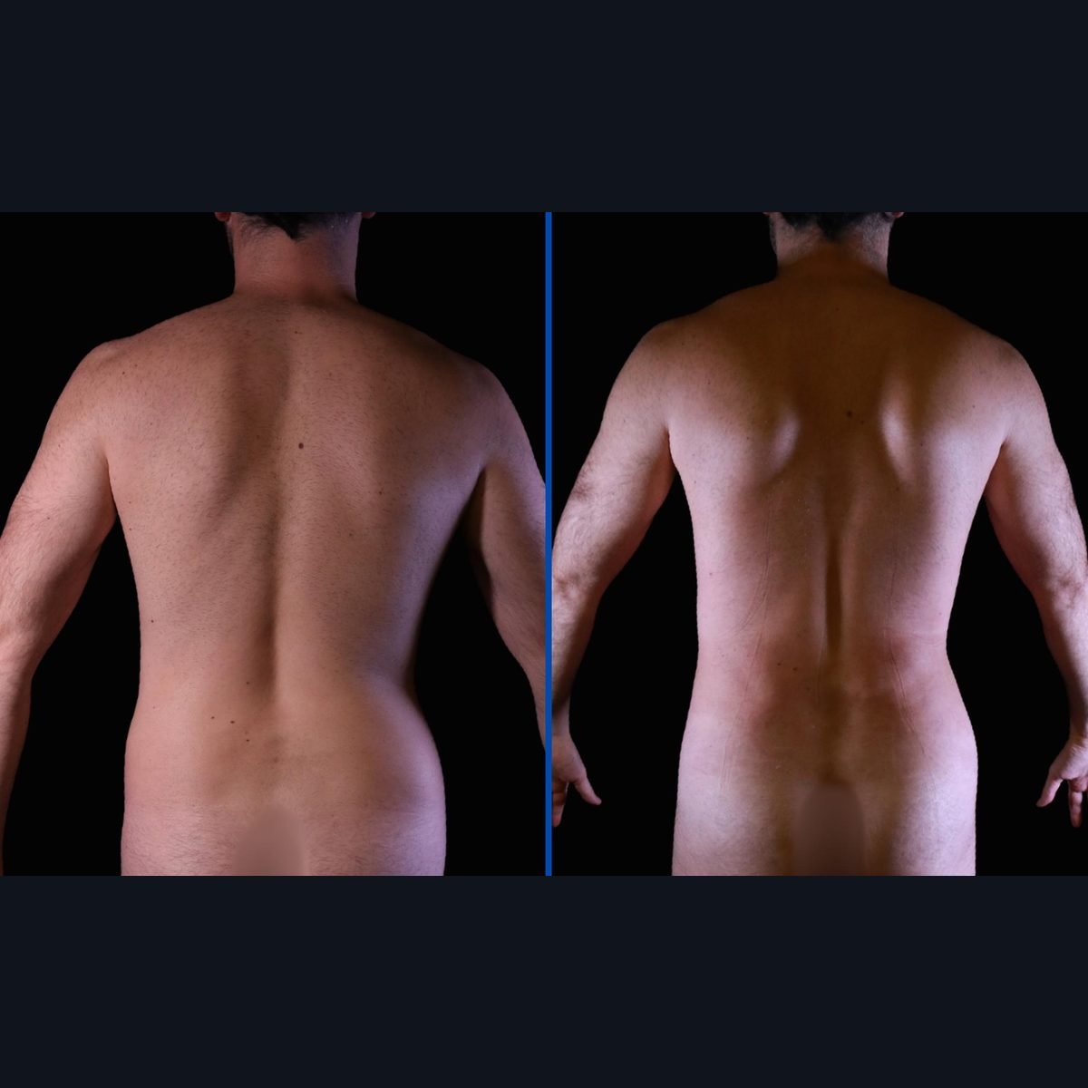 Liposucción de alta definición en hombres: espalda y cintura antes y después, Bogotá